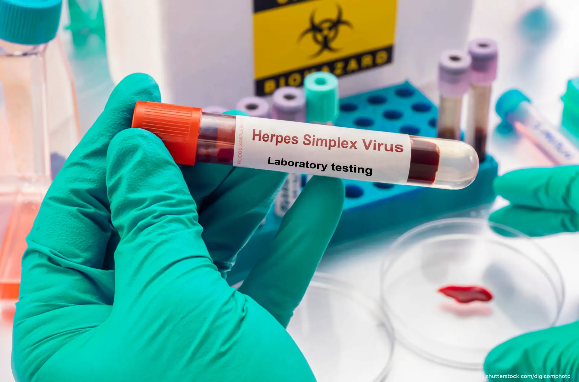 test tube containing a blood sample from a person infected with the herpes Simplex virus