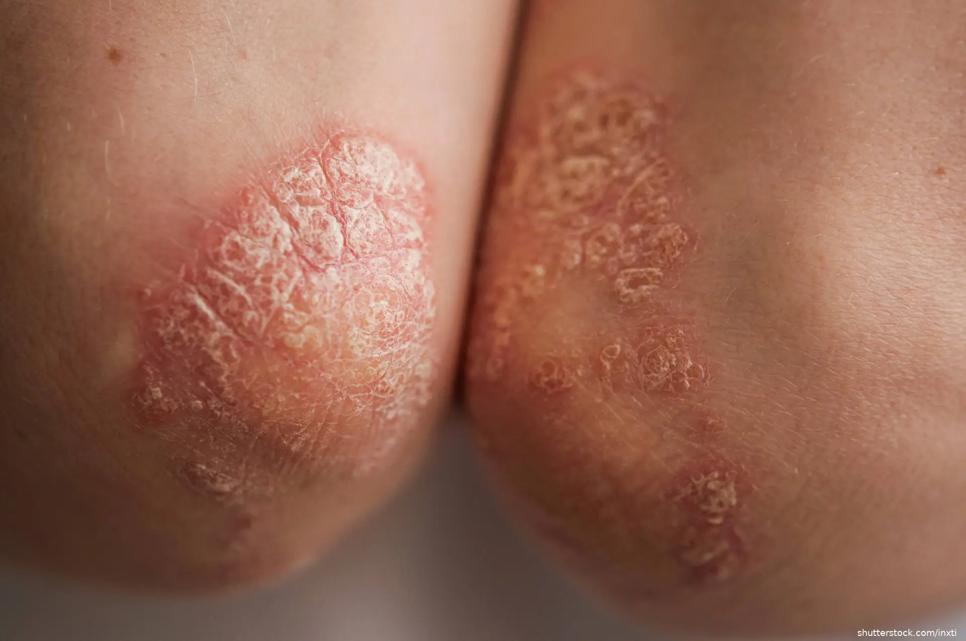 plaque psoriasis on elbow