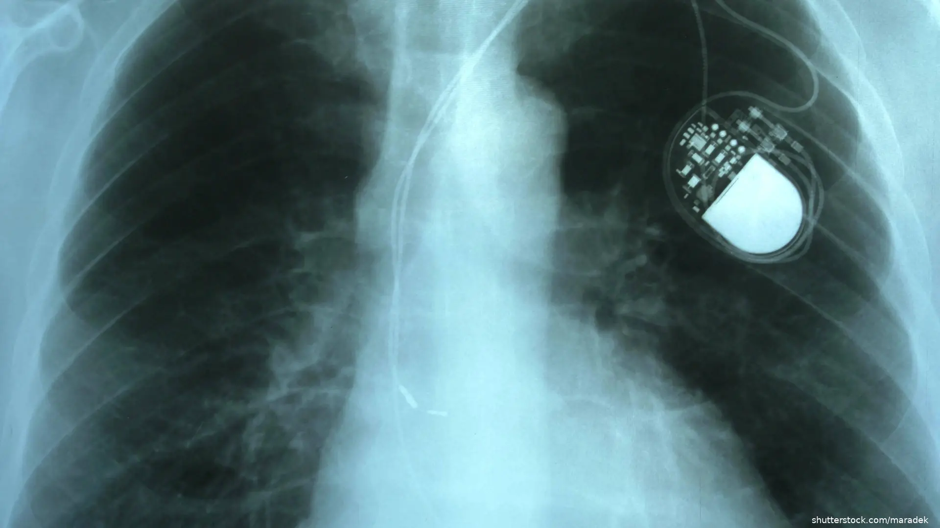 x-ray of chest showing cardiac pacemaker
