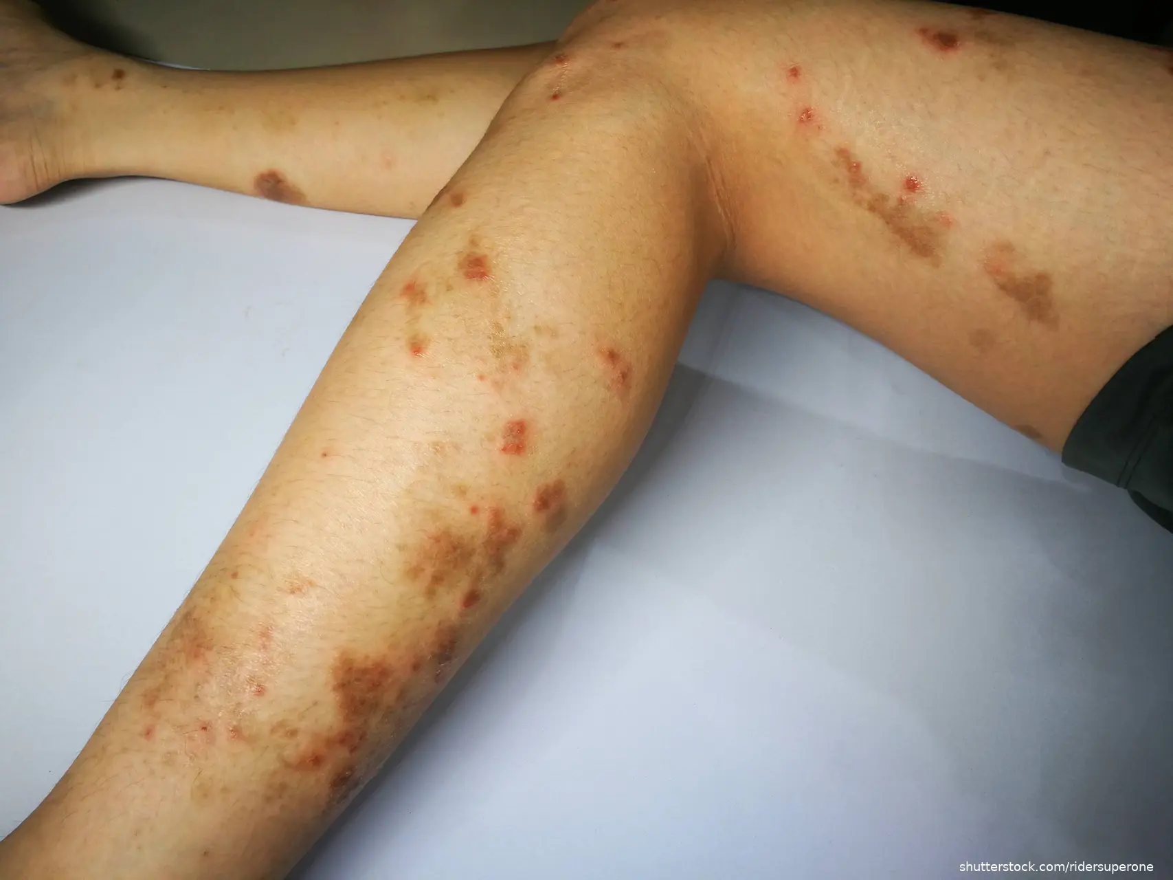 leg with multiple rashes photo