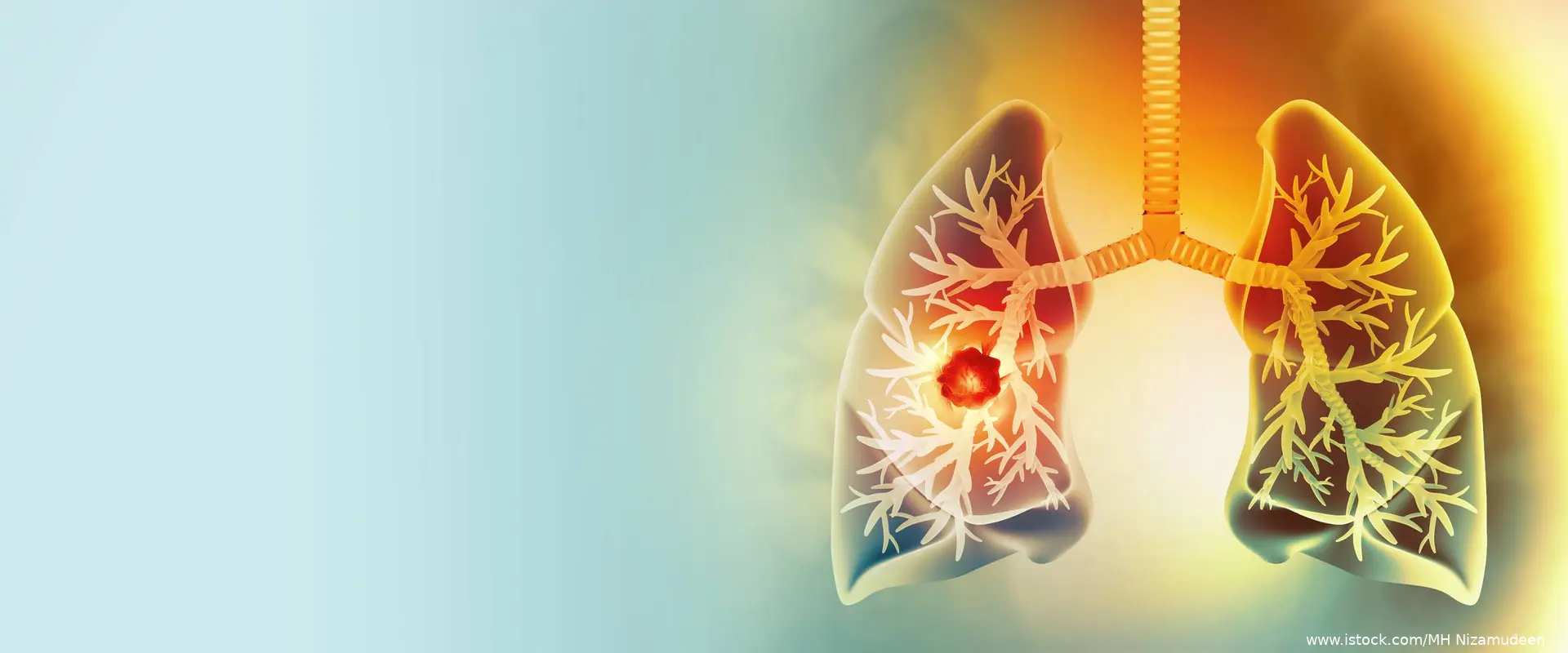 Image of lung with tumor