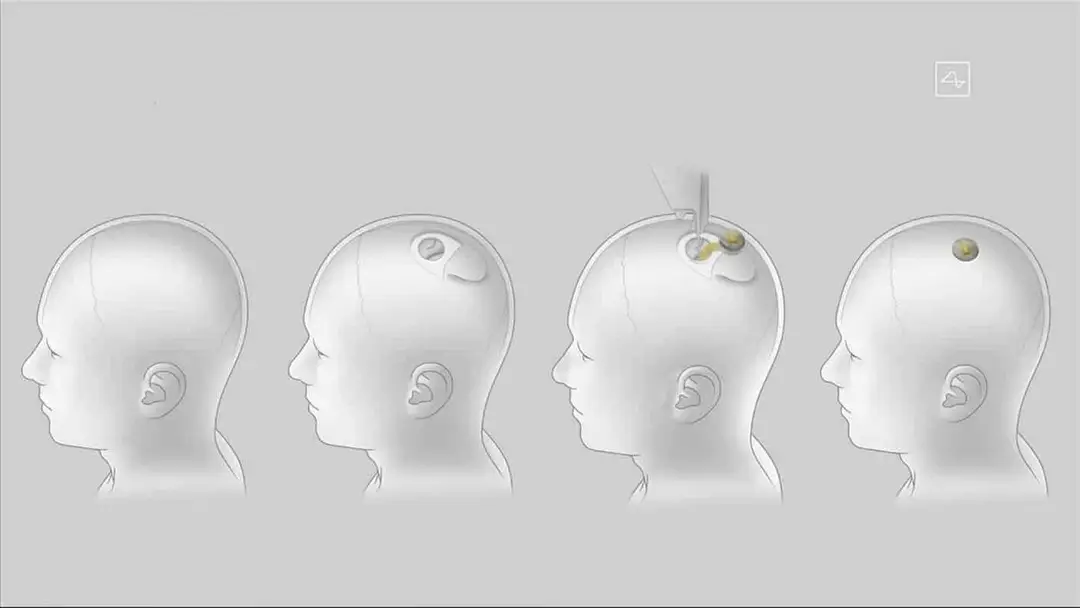 neuralink update