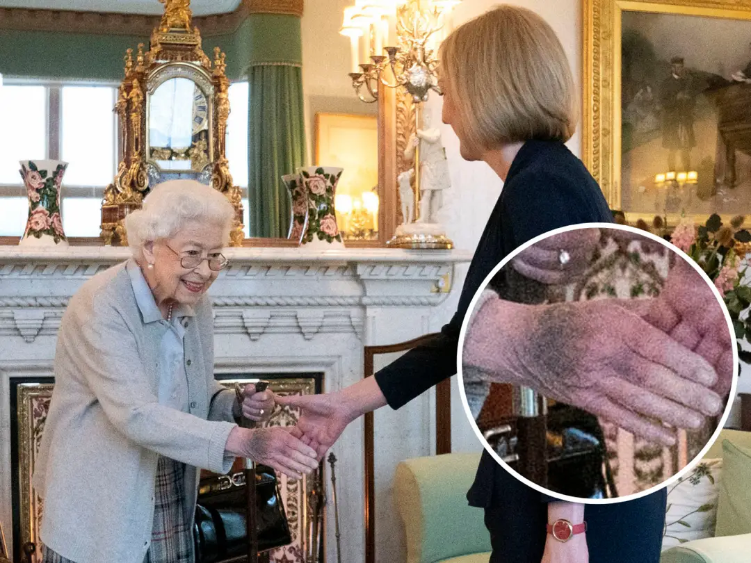 queen-bruised-hand