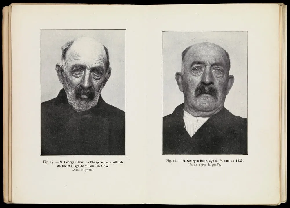 c389tude sur la vieillesse et la rajeunissement par la greffe wellcome l0068506