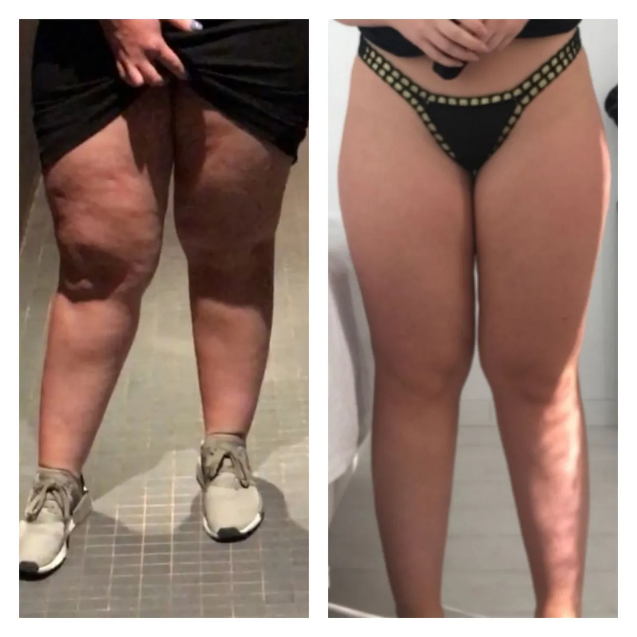 cellulite lipoedeem