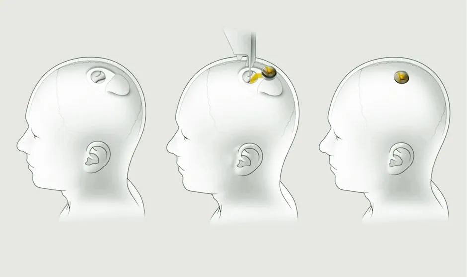 neuralink installation