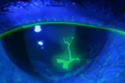 herpes keratitis