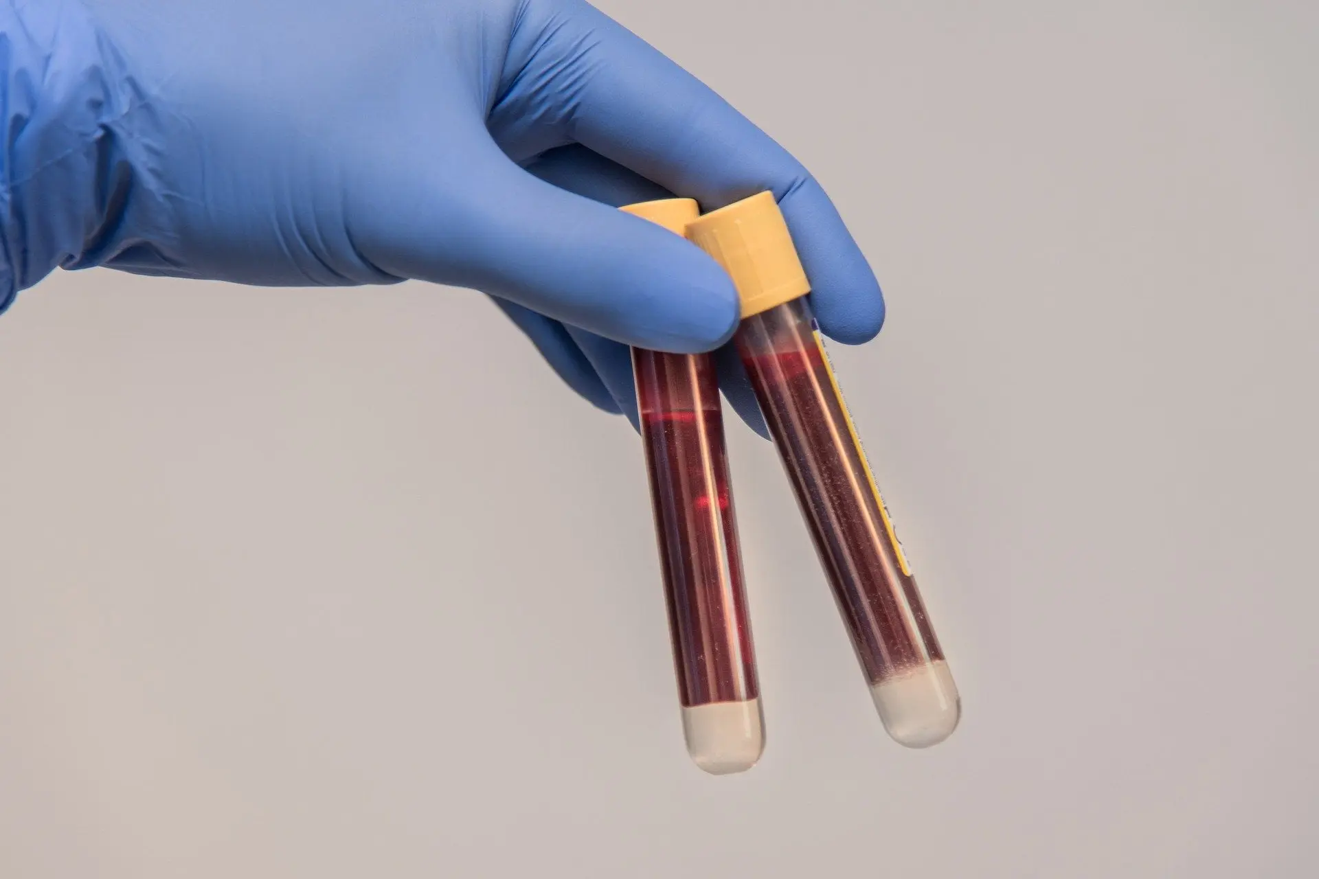 blood sample g7c9de9e50 1920