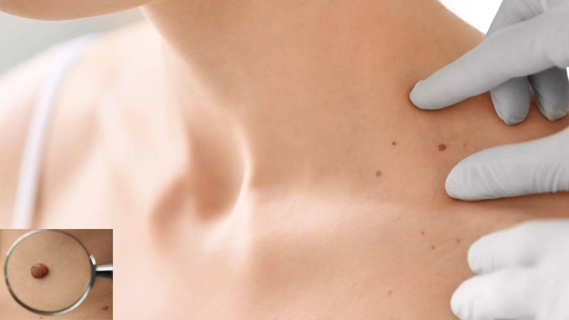 birthmark