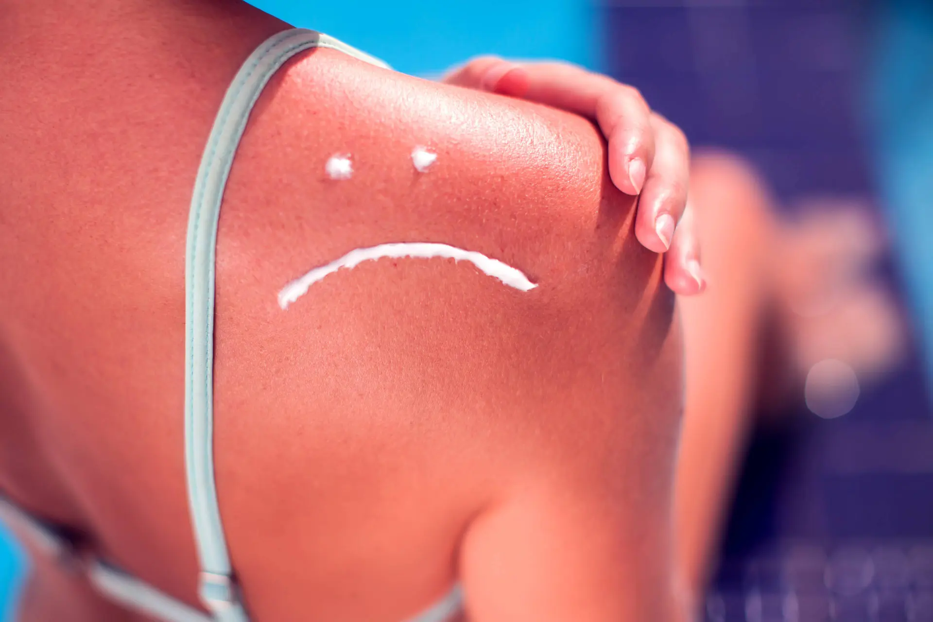 sunburned
