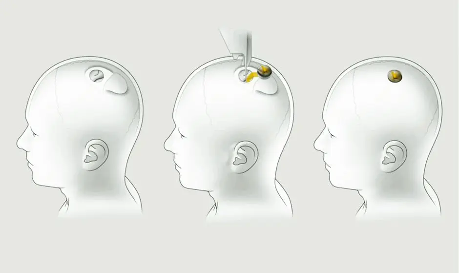 neuralink installation