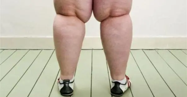 obesitas