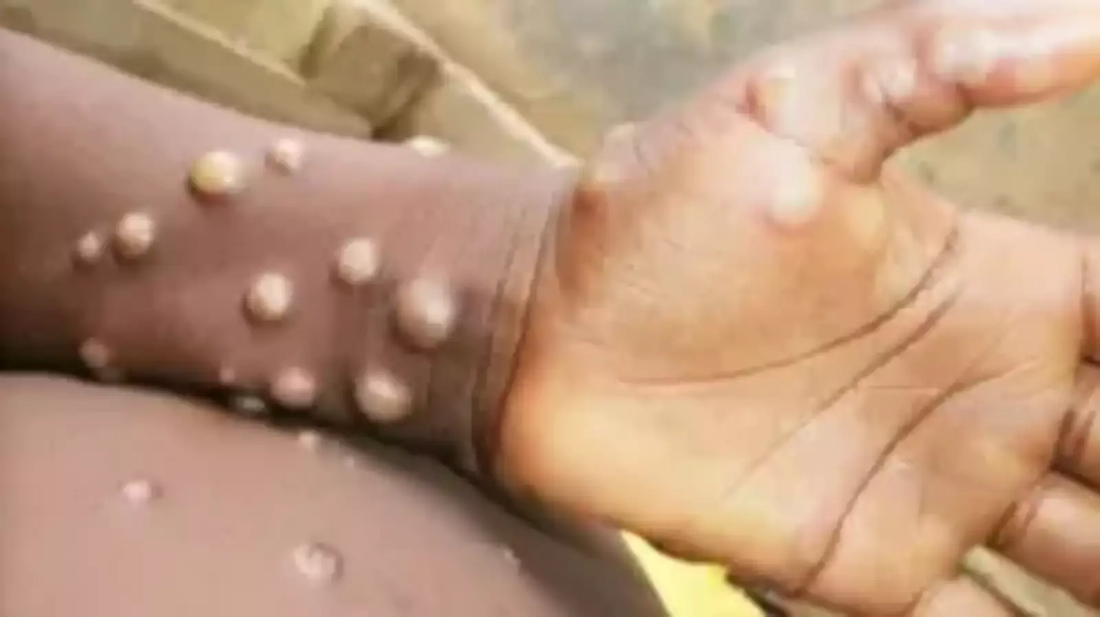 mpox outbreaks what you need to know about the global health emergencyjpg