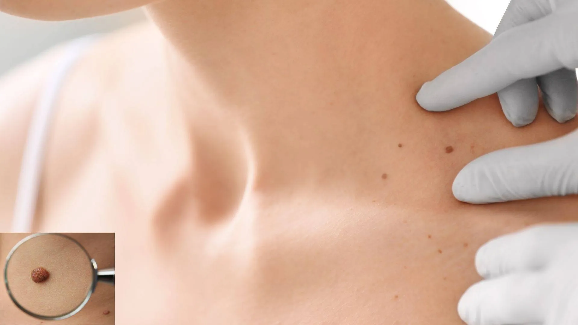 birthmark