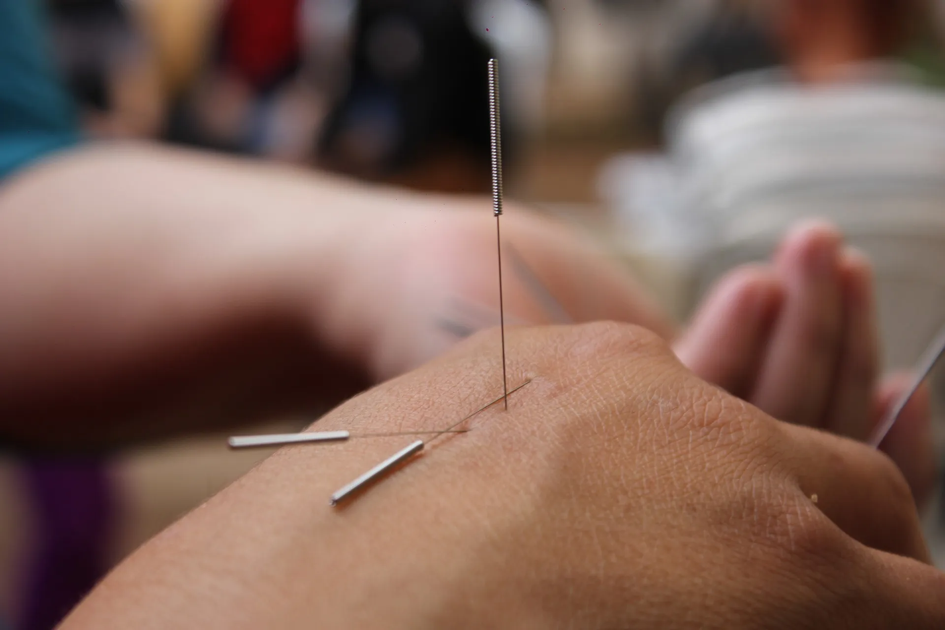 acupuncture 6324472 1920