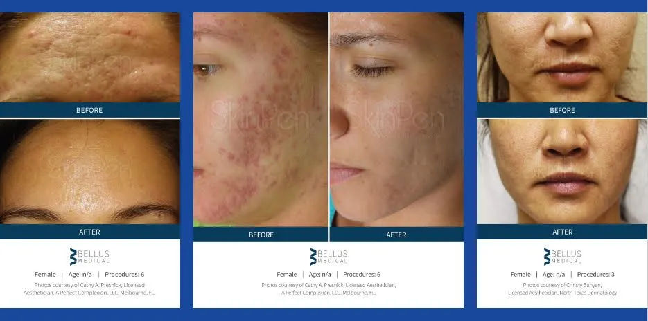 skinpen