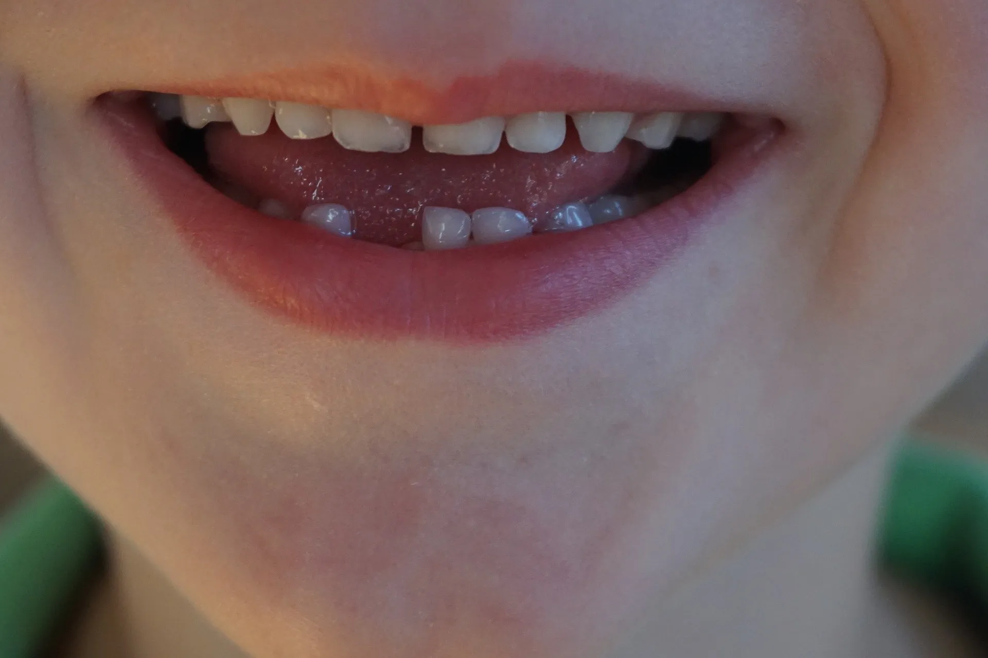 tooth gap 2019489 1920
