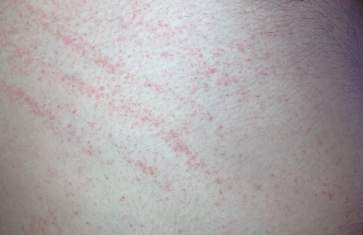 scabies thorax schurft cc bys a 30 fhgd1