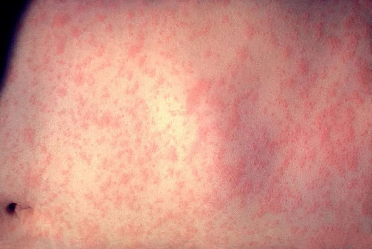 morbillivirus measles infection f5881a