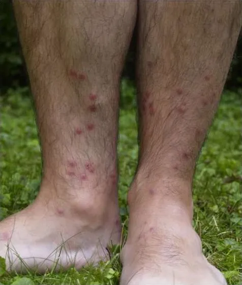 zwemmersjeuk cercarial dermatitis lower legsjpg wikimedia