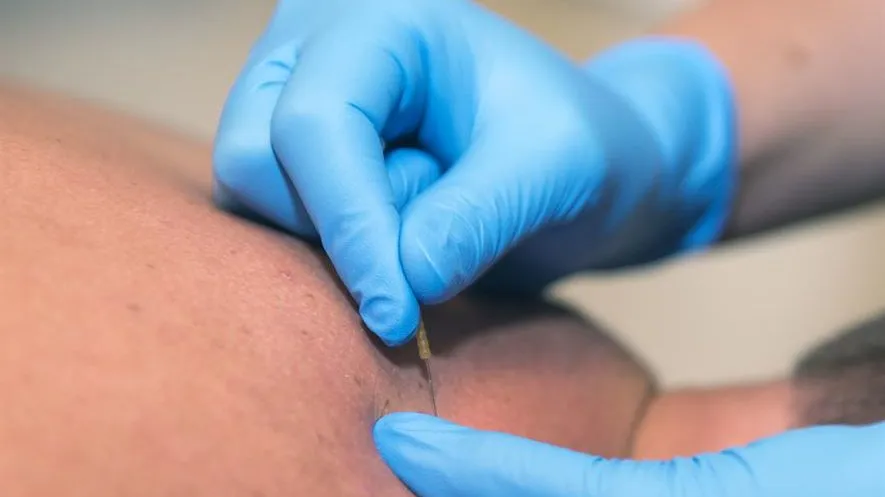 dry needling e1493984847847