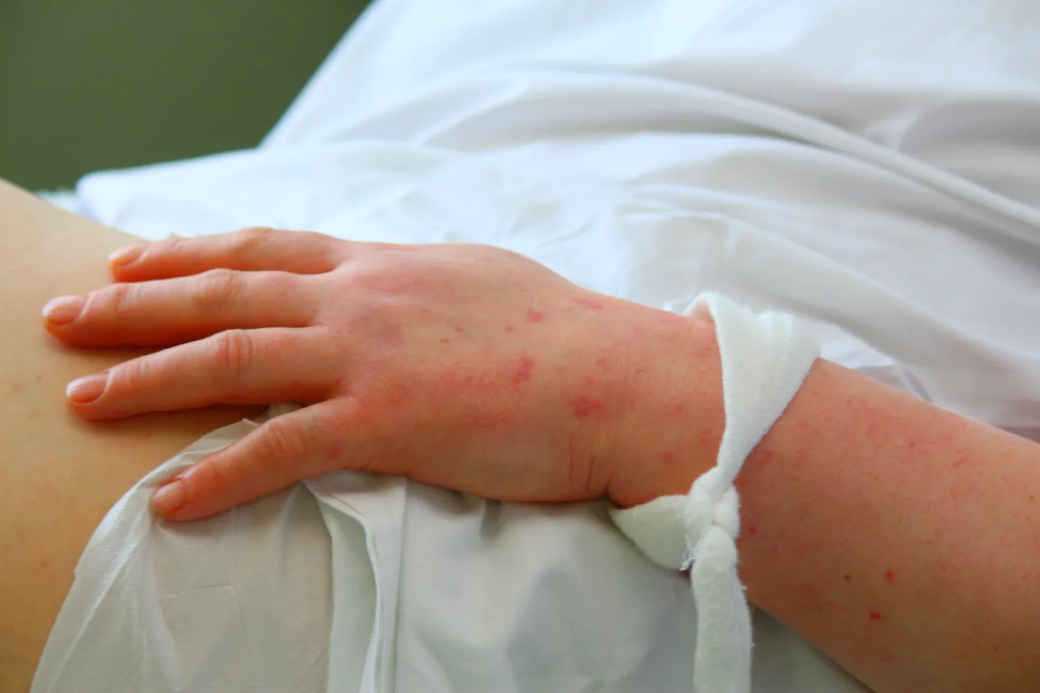 Meningokoko infekcija/ Bėrimas