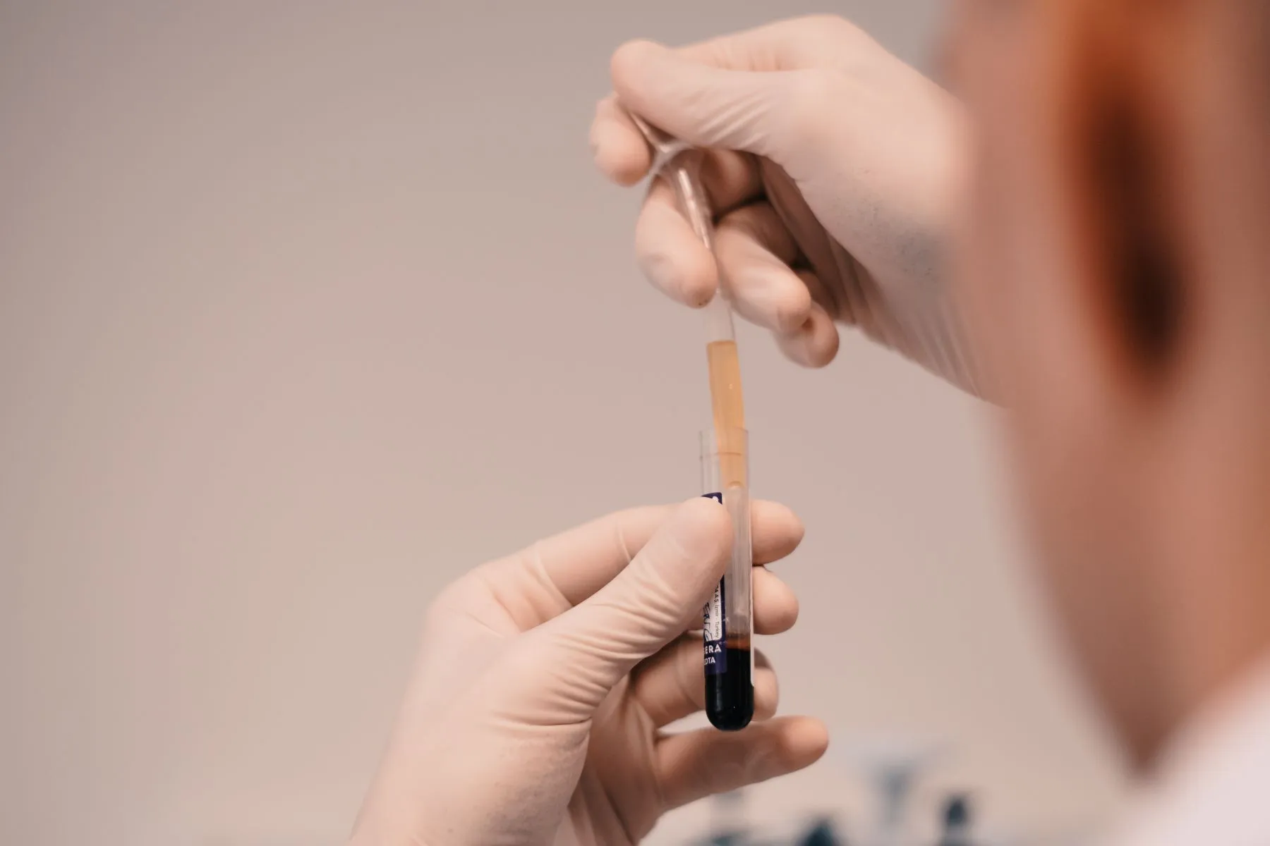 Tuberkuliozė, adata, skiepai, ligoninė, gydymas, koronavirusas