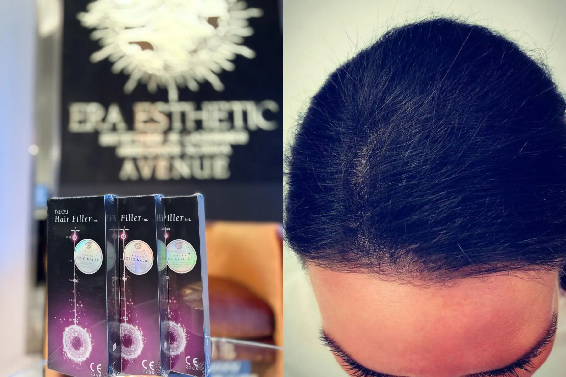 „Dr. Cyj Hair Filler“ metodas „Era Esthetic“ klinikoje / Organizatorių nuotr.