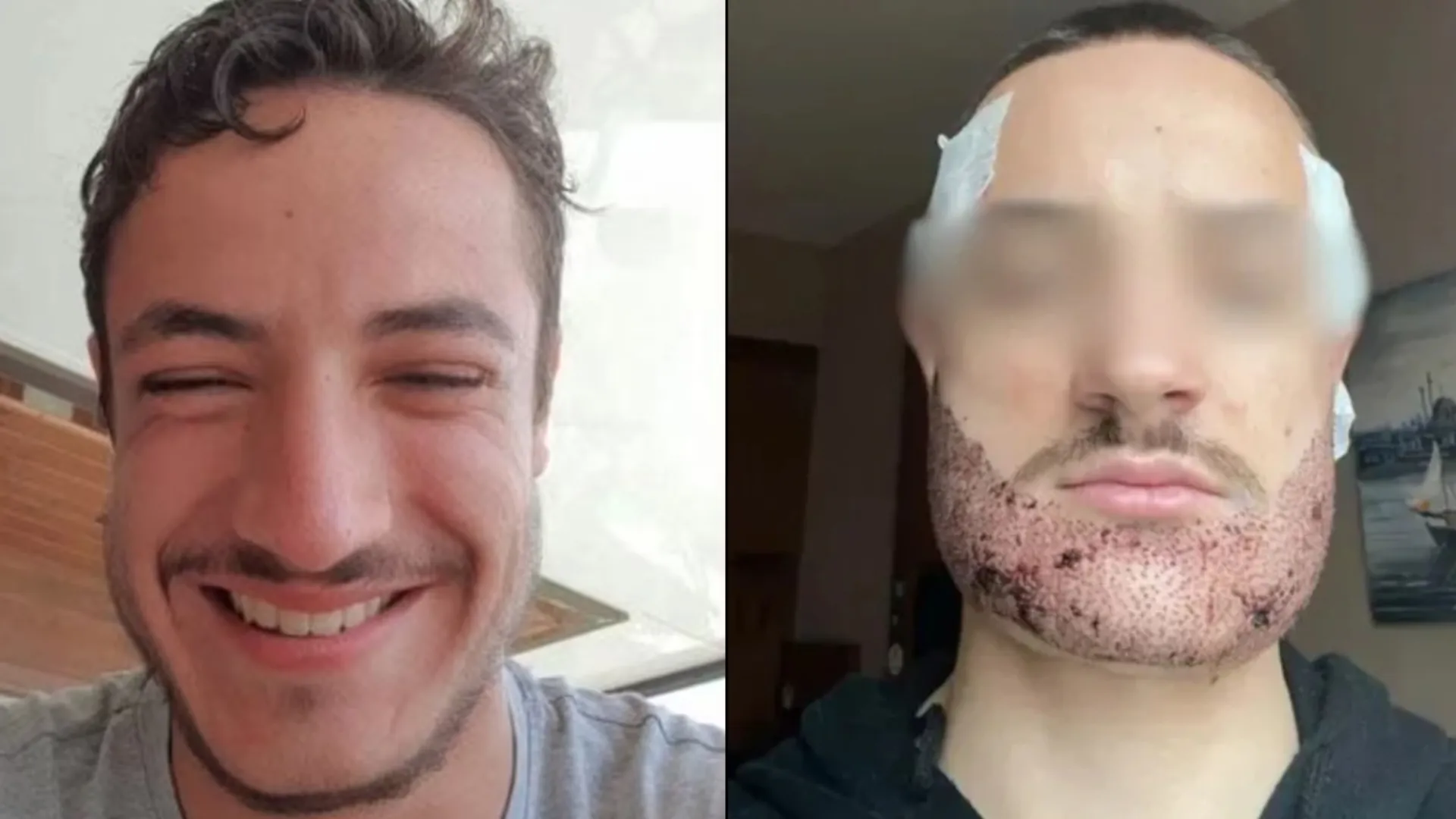 botched beard operation