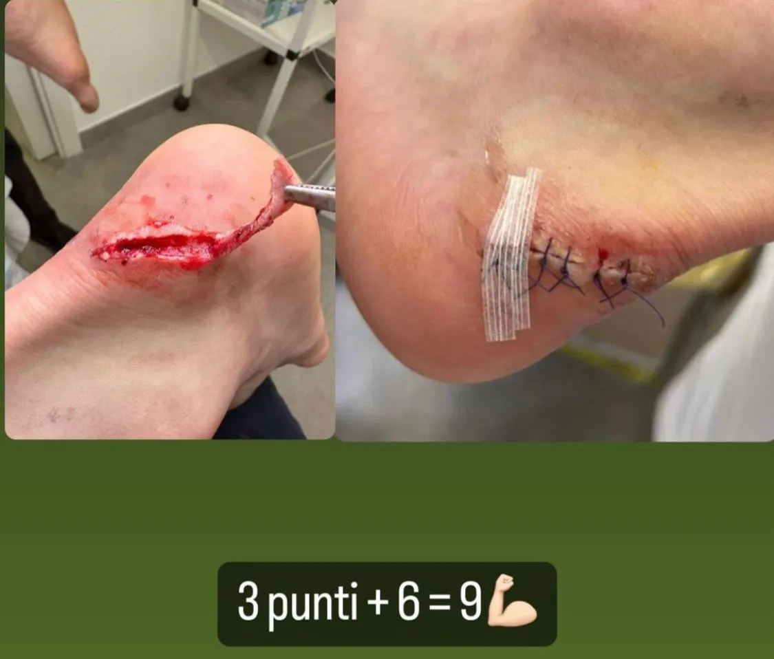 instagram ibanez ferita roma juventus 1