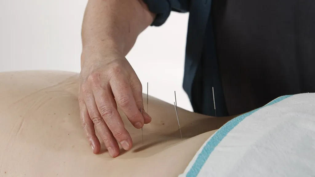 acupunktuur