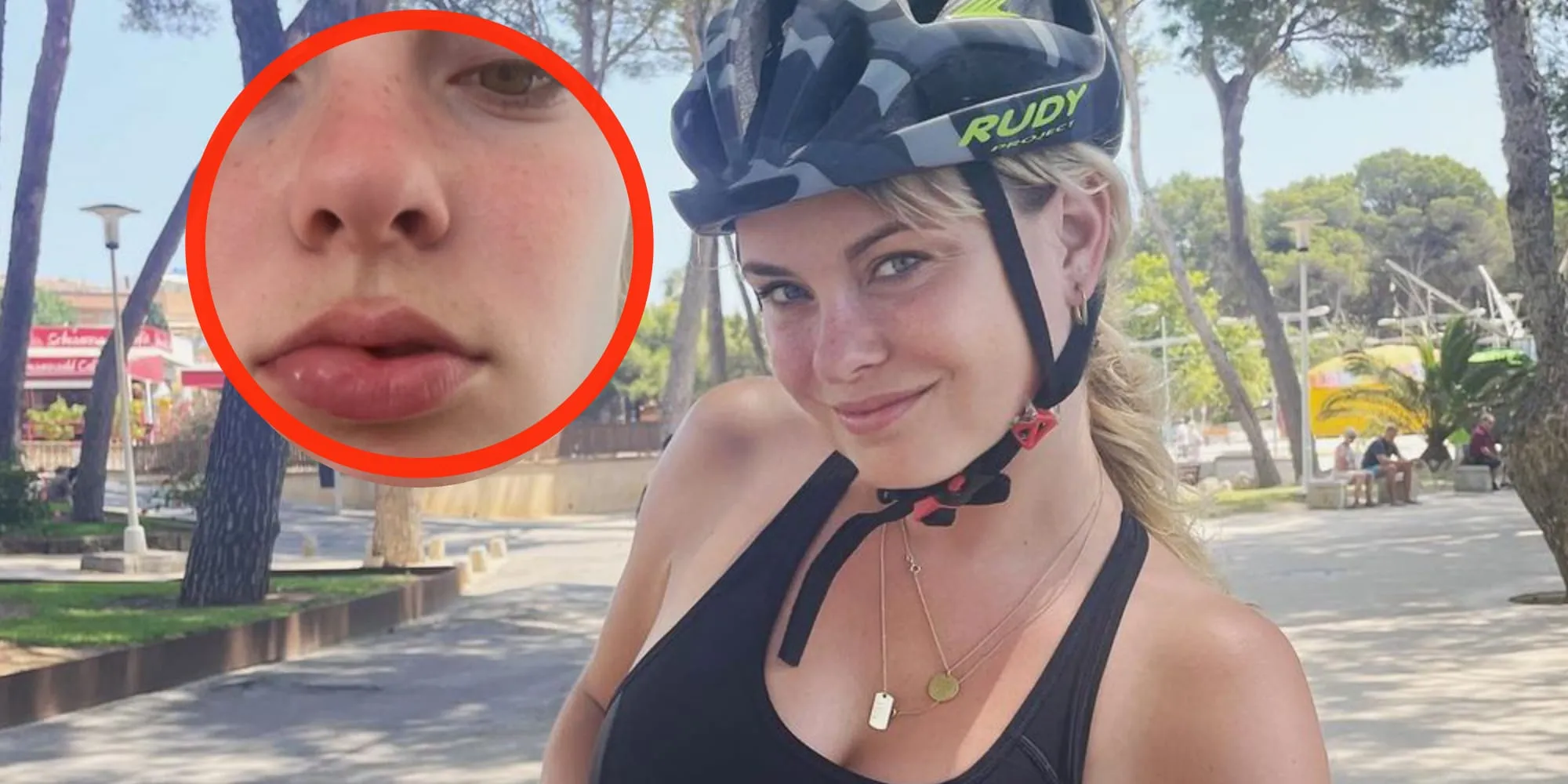 foto sylvana ijsselmuiden laat gezwollen lippen zien na fietstochtje