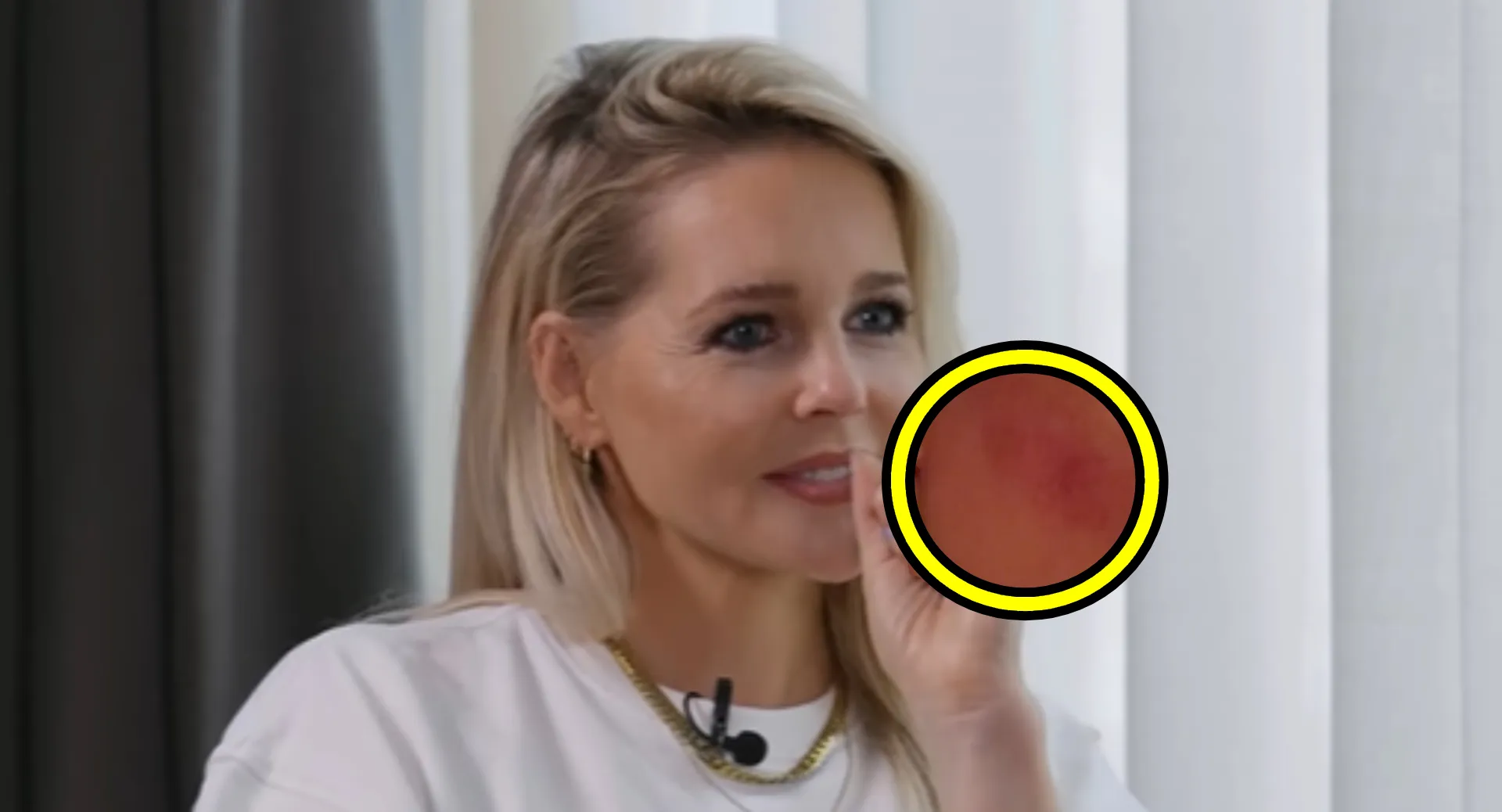 chantal janzen gebruikt te veel zuigkracht en veroorzaakt rode vlek op onhandig plekje fotos