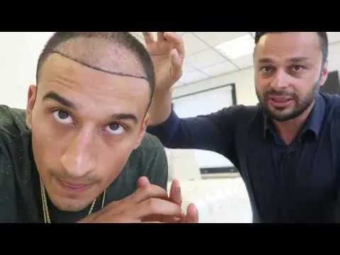 nesim gaat voor zijn 2e haartransplantatie