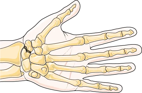 fracture scaphoide
