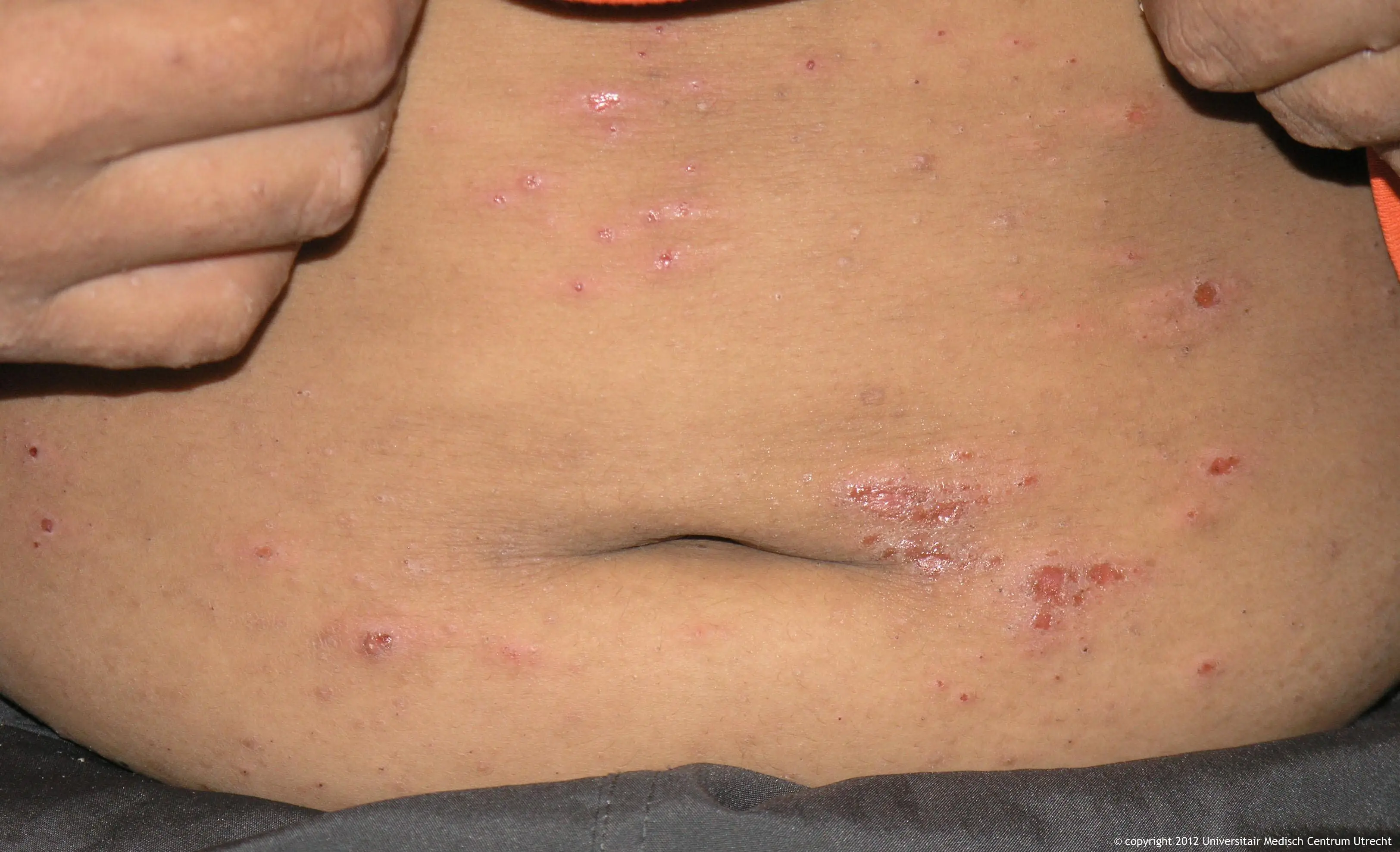 scabies romp m 8 jr