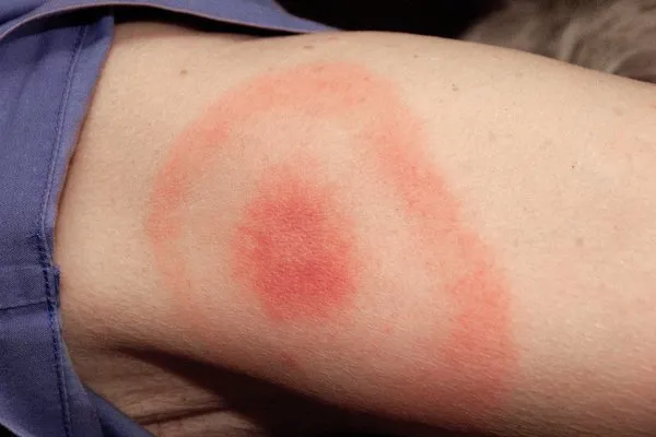 s 0817 lyme disease c0031417max 600x600 1