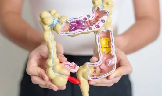 afbeelding darmkanker