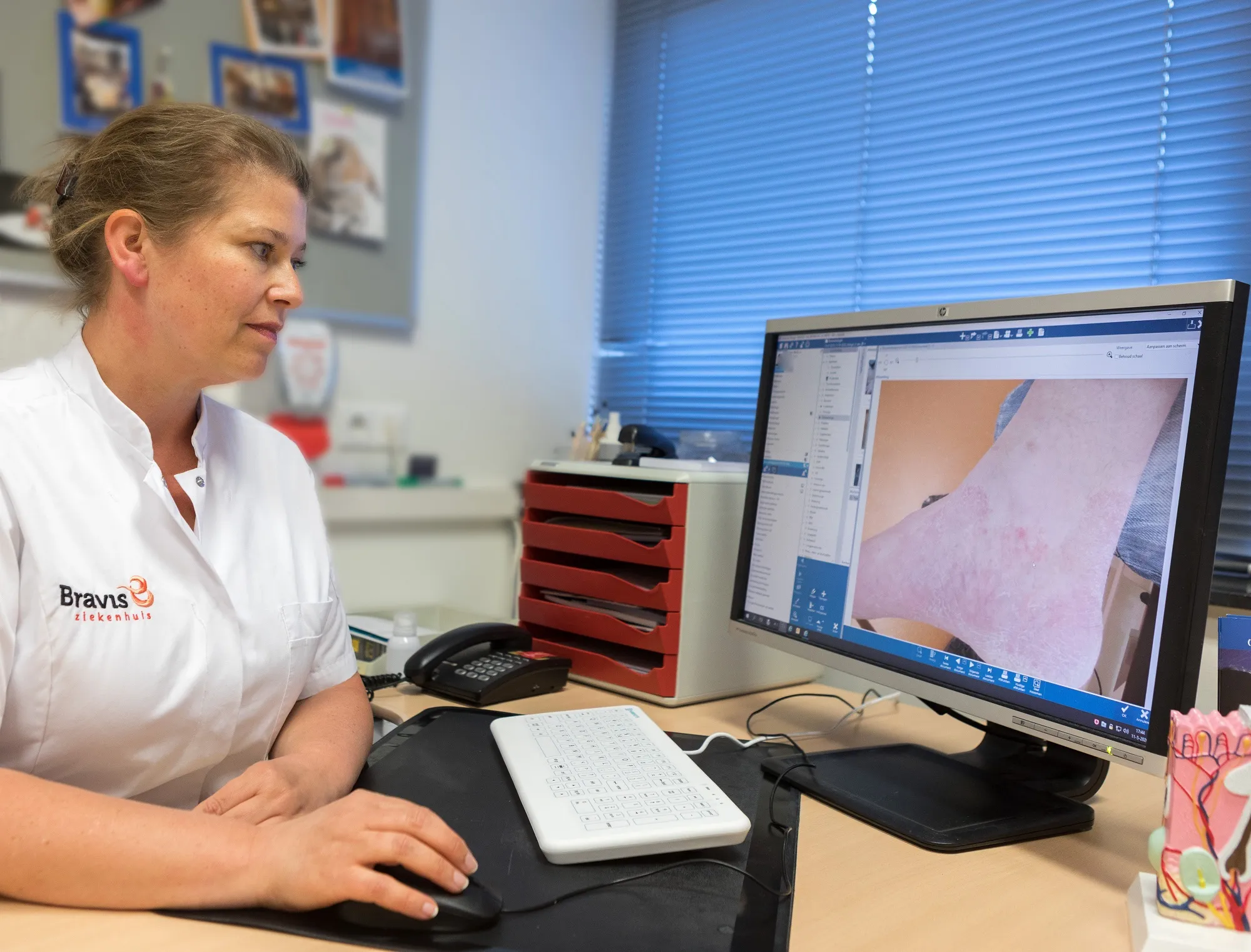 bravis dermatologen missen door corona patienten met huidkanker