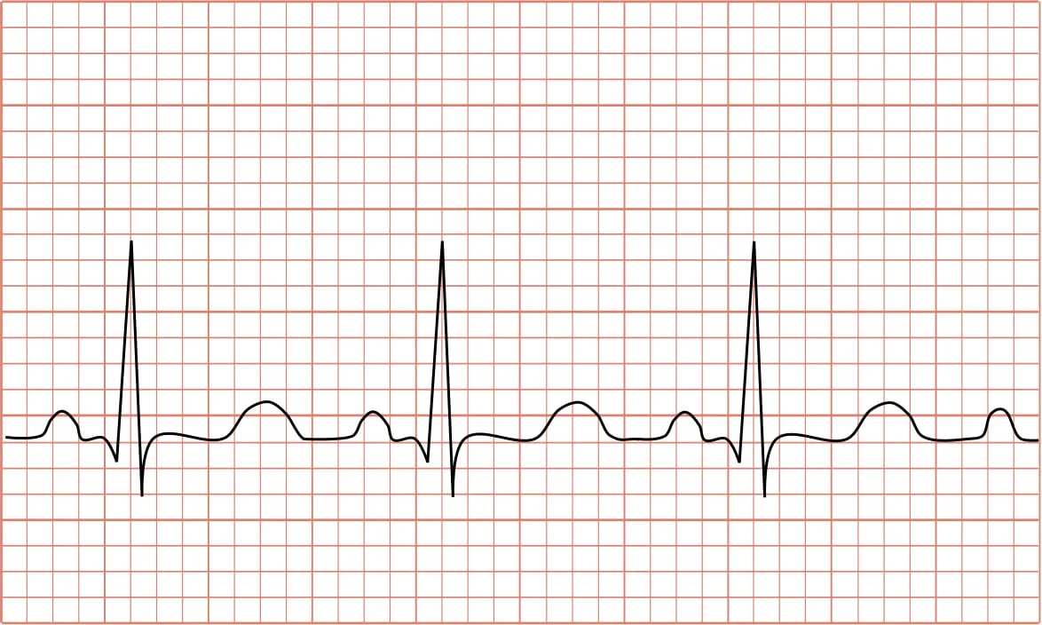 ecg hartfilmpje