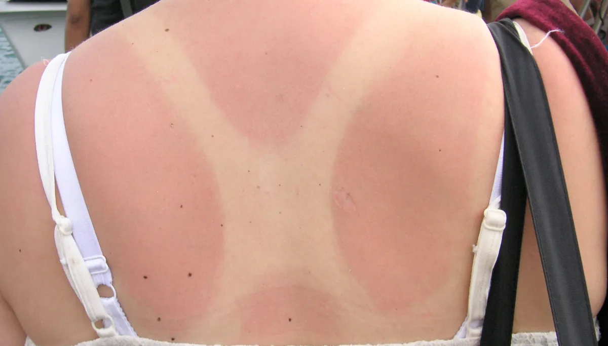 flickr 296893104 818a03cbee o zonnebrand beatrice murch cc by 20