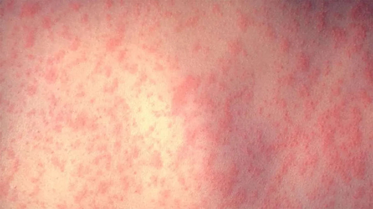 huid persoon met mazelen