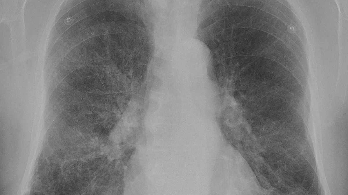 longen copd patient