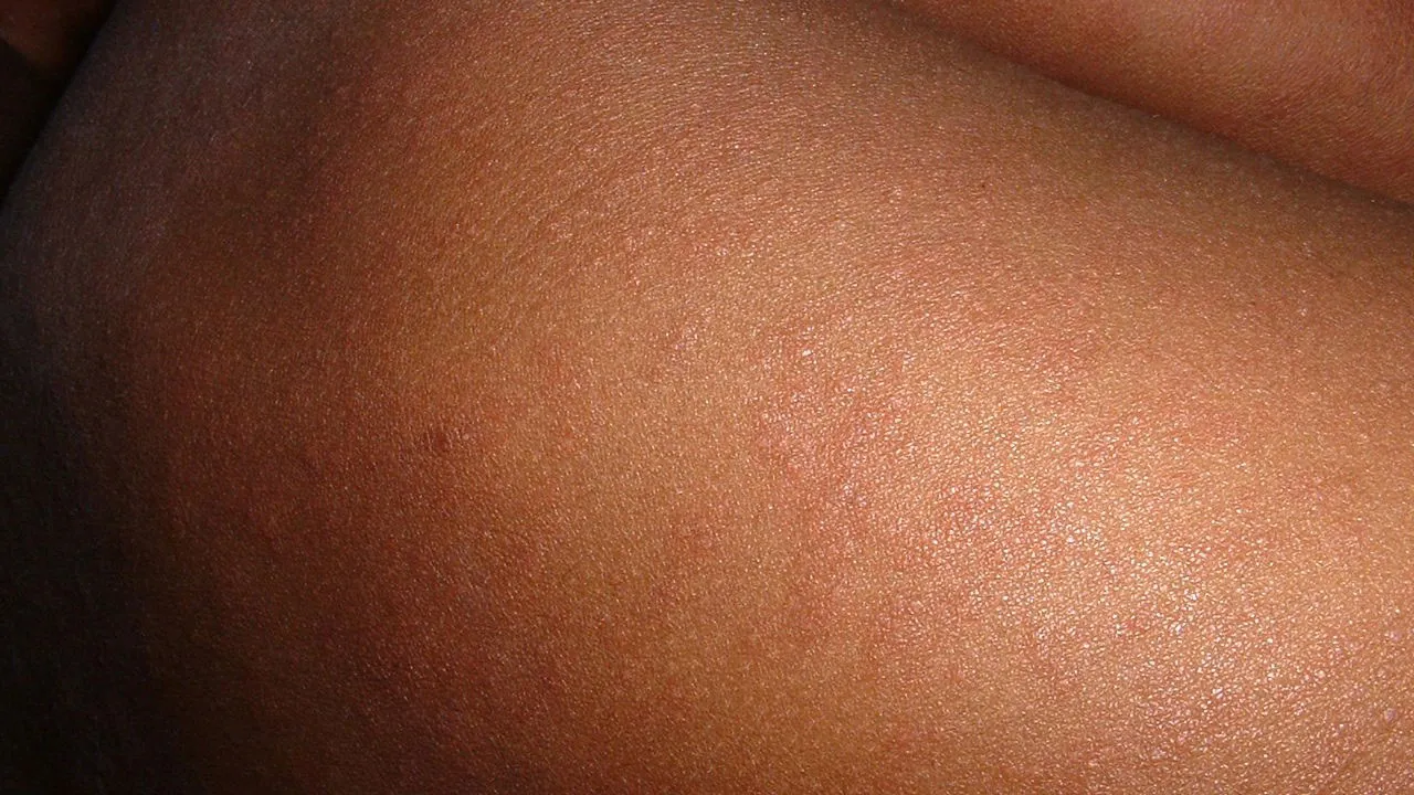 mazelen cc0 pixabay measles 648479