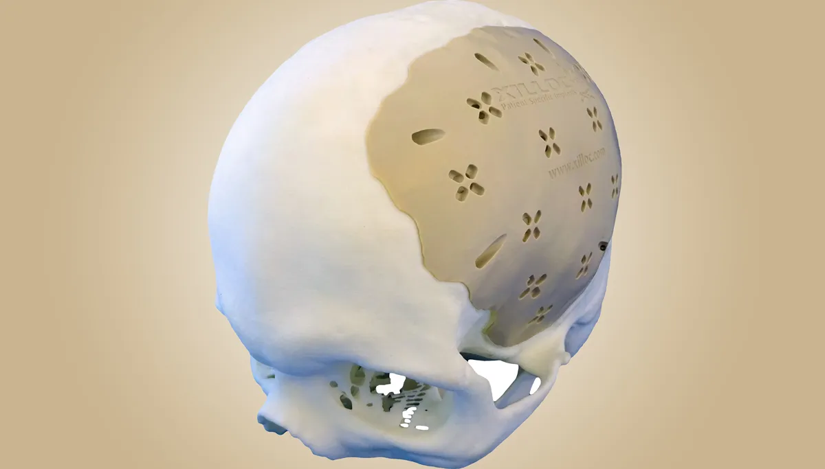 persbericht xilloc 20150507 foto schedel botimplantaat