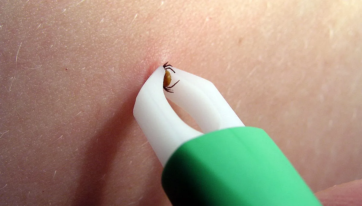 teek verwijderen met tekenpincet evanherk cc by sa 30 via wikimedia commons