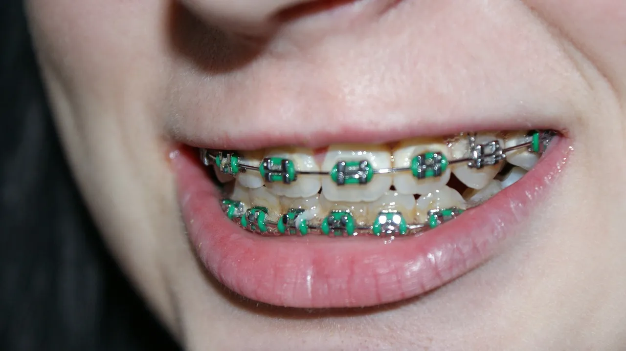 tooth 366335 1280 beugel orthodontie