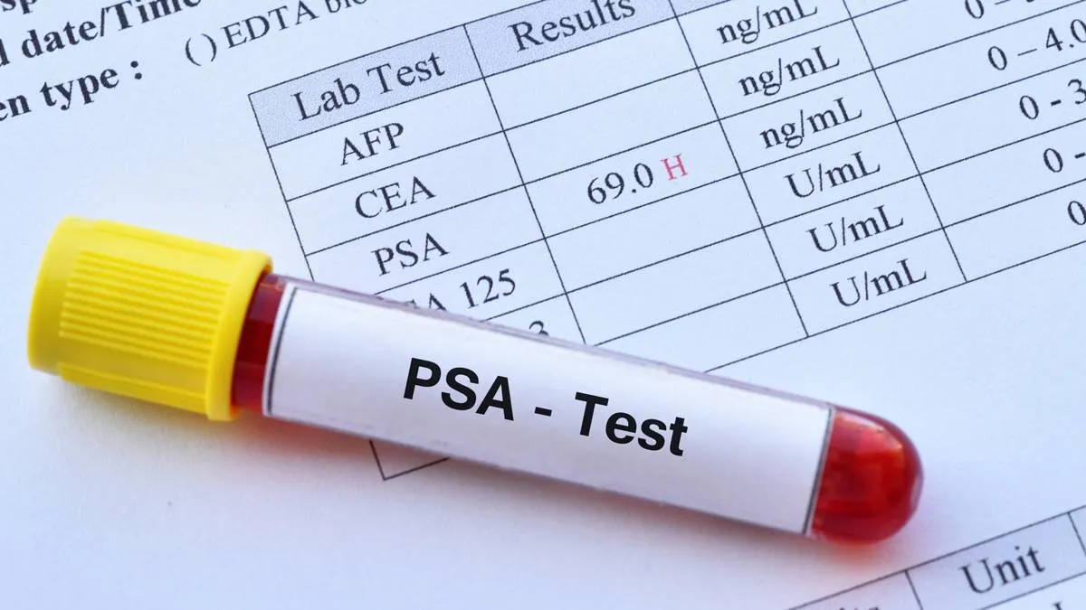 abnormal high psa test result with blood sample tube