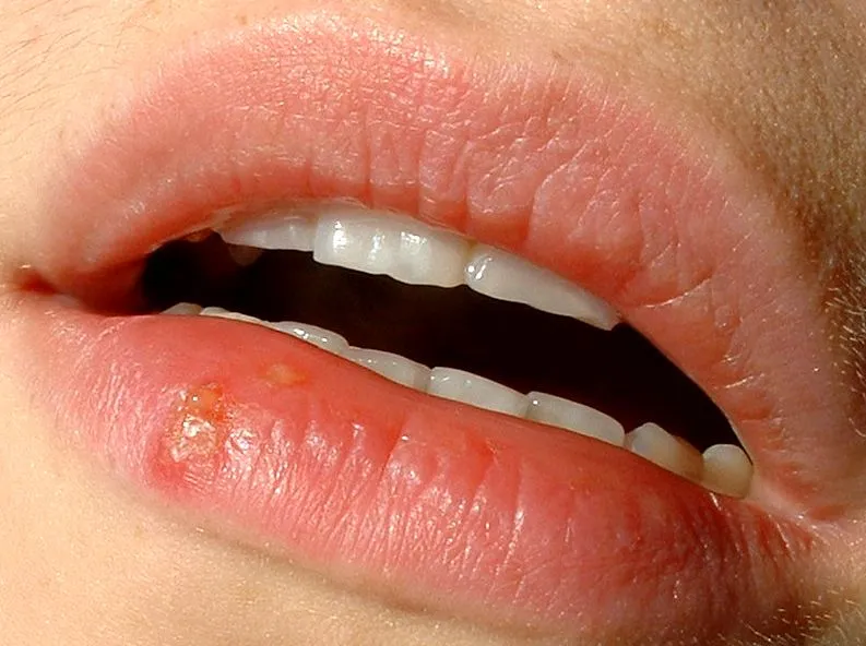 herpes labialis
