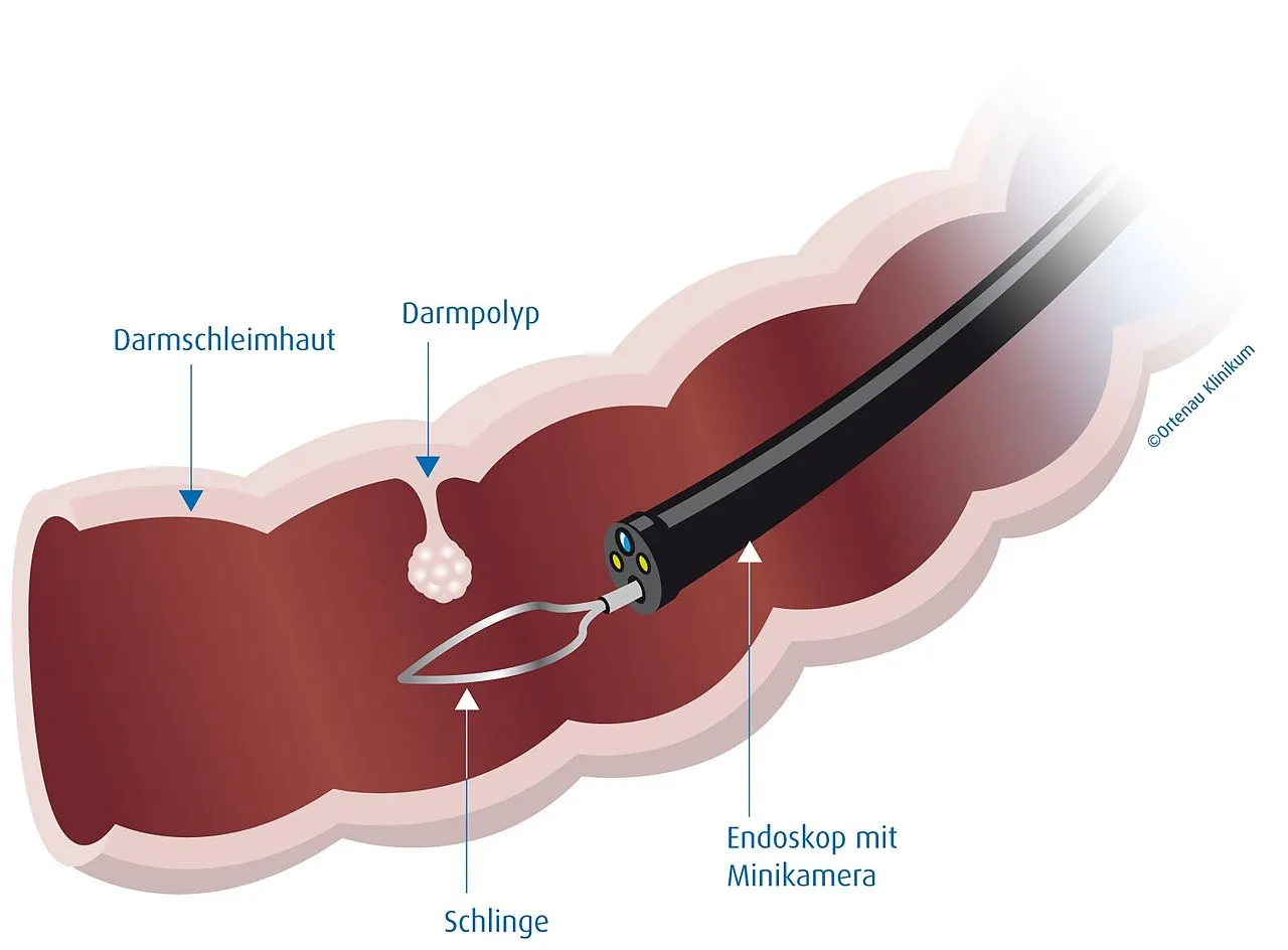 ortenau klinikum darmspiegelung